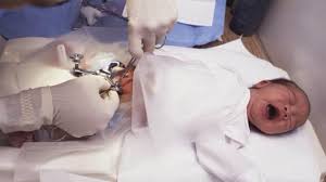 Circoncision